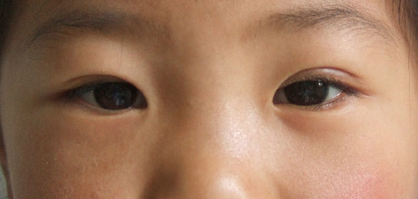 上睑下垂手术注意事项