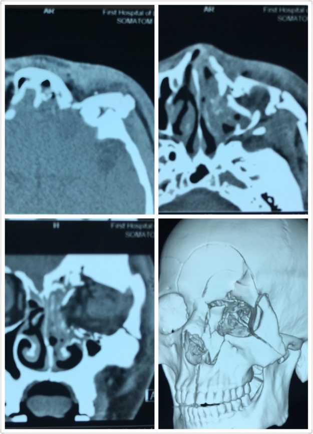 【病例分享】眼眶多发骨折伴眼球破裂