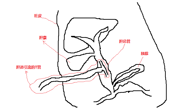 图三 t管放置两周后,腹腔内网膜开始包裹引流管