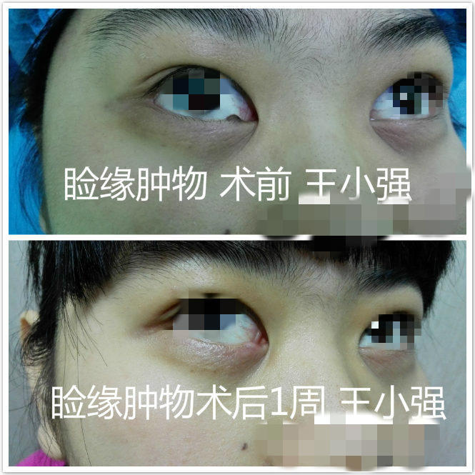 眼睑睑缘肿物手术注意事项图片
