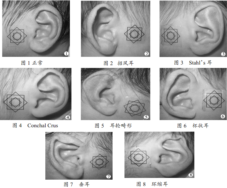 新生儿耳廓形态畸形的无创微整形技术