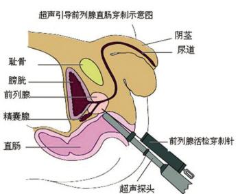 对可疑者,做前列腺穿刺活检确诊(前列腺细针抽取前列腺组织标本送病理