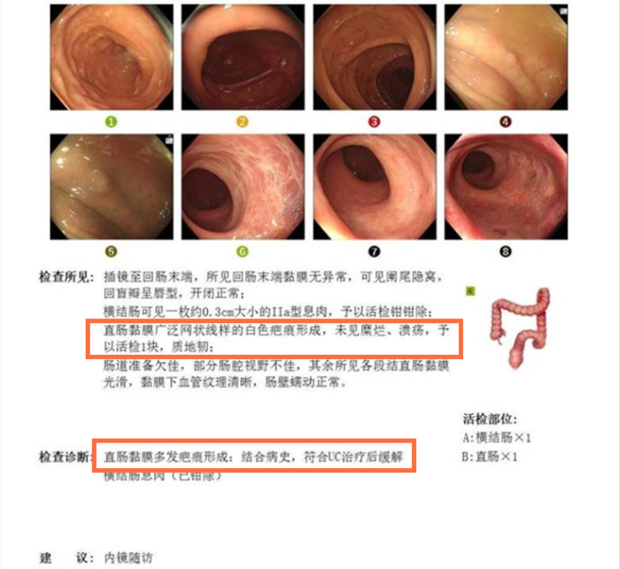 再次证明,对于远端直肠,直肠乙状结肠的溃疡性结肠炎,青玉散可以让肠