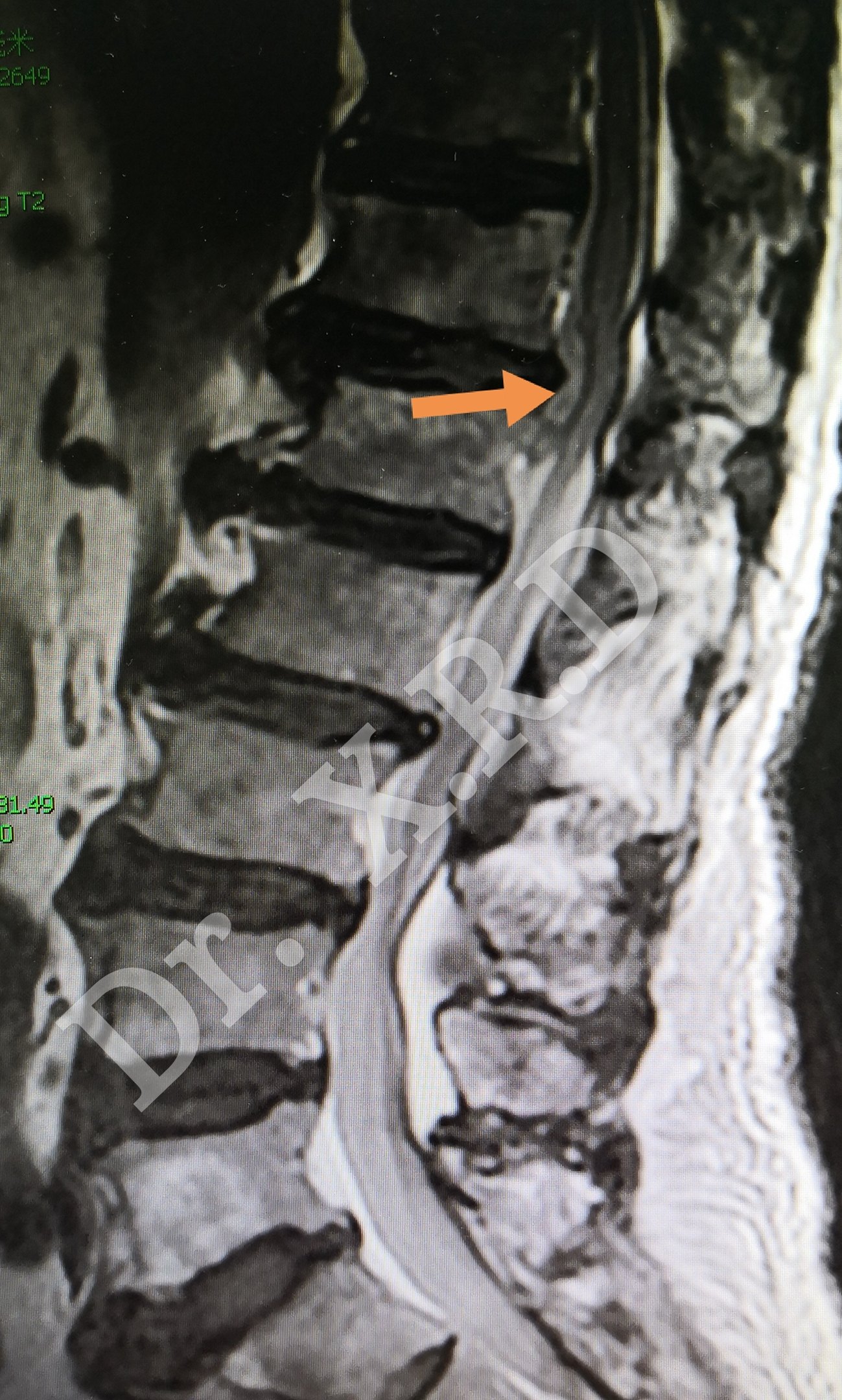 高龄高风险高位椎间盘突出的脊柱内镜治疗