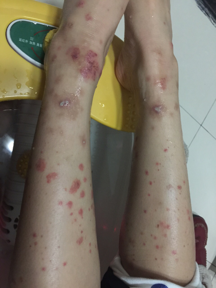 确认 顶11 分享: 相关推荐: 皮肤肿胀,红斑,紧绷,警惕硬皮病!