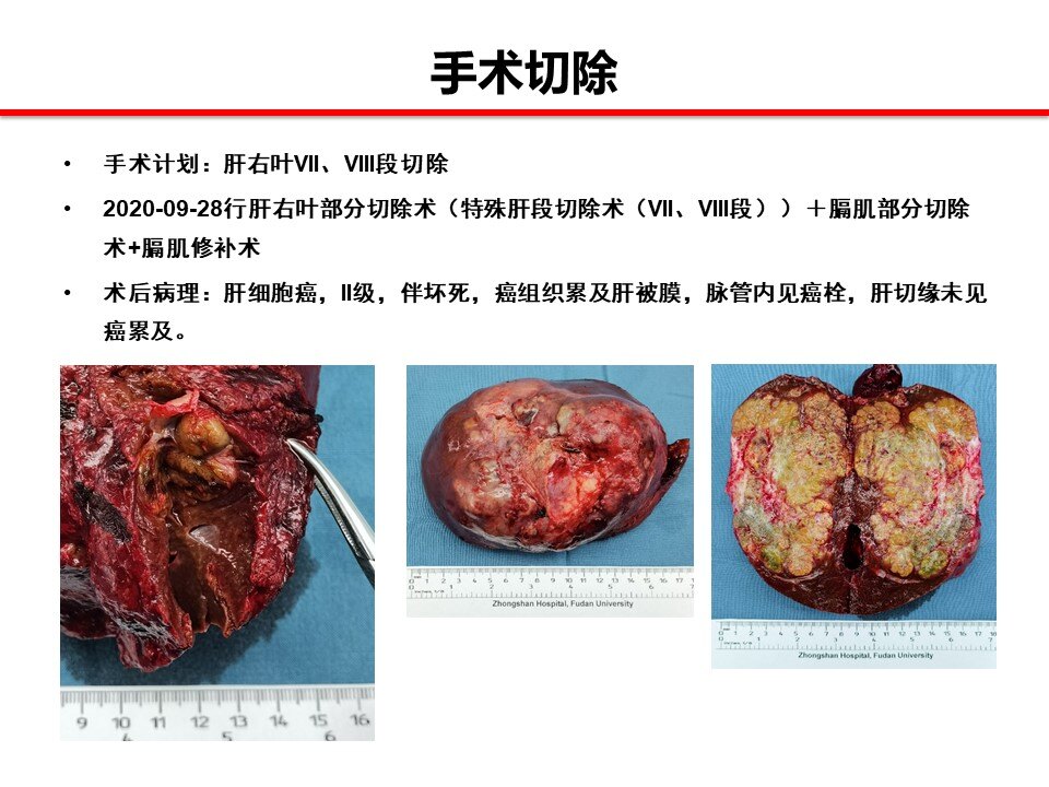 一般情况介绍原发性肝癌是严重威胁我国国民身体健康的恶性肿瘤之一