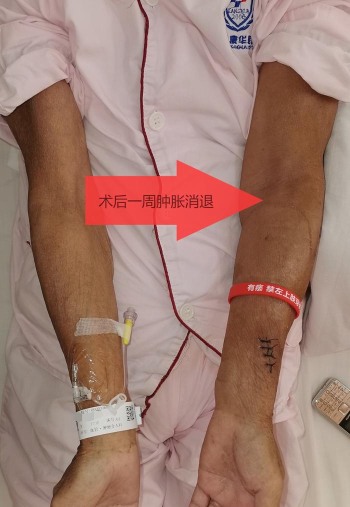 少见 造瘘后一周出现肿胀手 微医(挂号网)