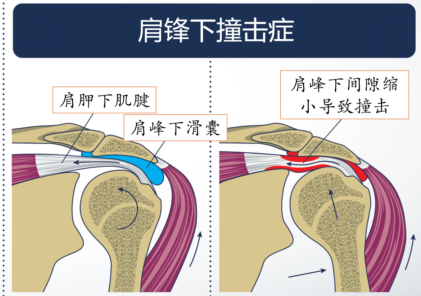 二魔头:肩峰下撞击症肩袖损伤一开始可能只是一些微小的撕裂破口,而
