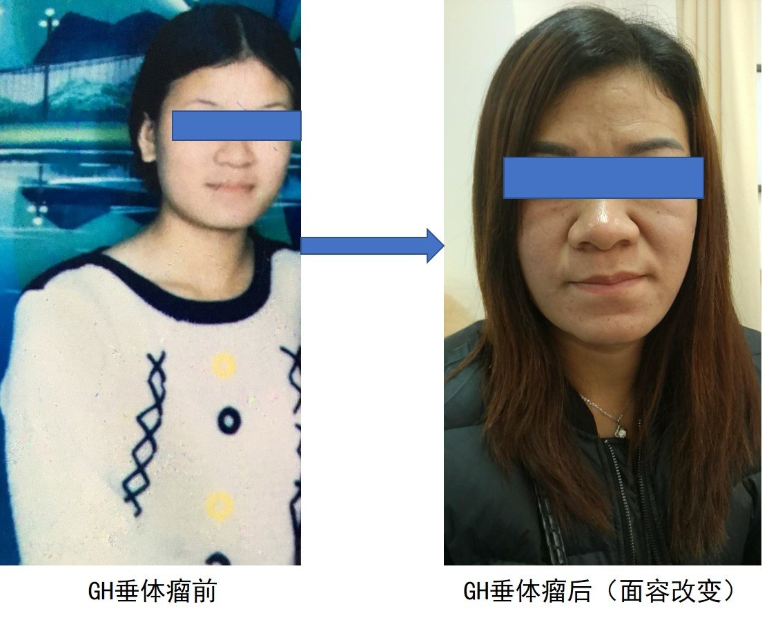 好久不见面容改变警惕肢端肥大症