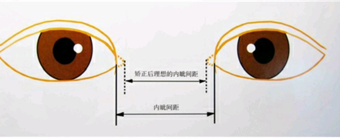 为什么要做开眼角手术内眦开大手术