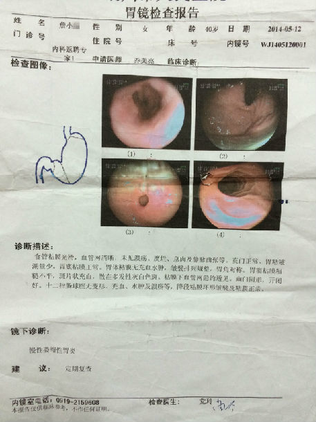 膏方治疗萎缩性胃炎患者的胃镜病理前后对照图片