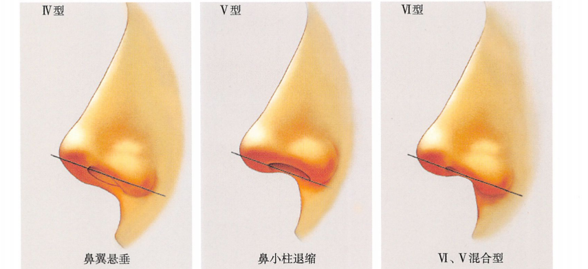什么是鼻翼整形能够治疗哪些问题