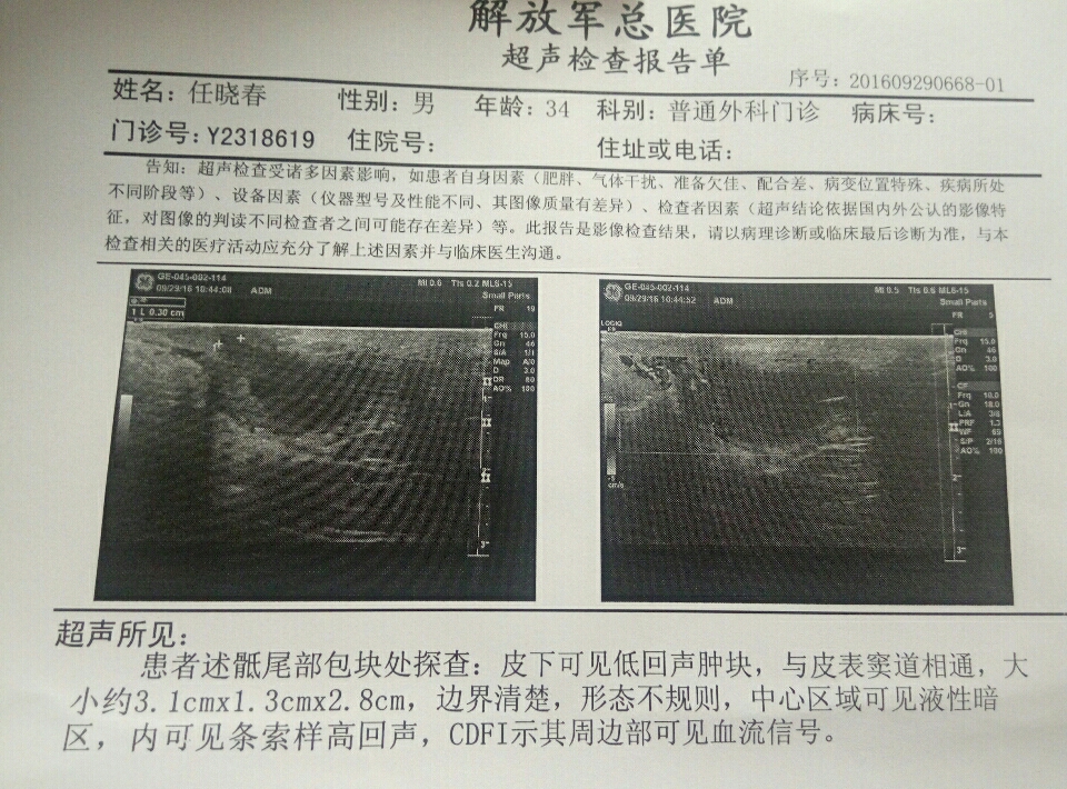 骶尾藏毛窦怎么能彻底治好啊!