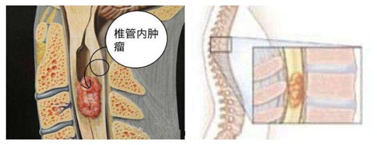 脊柱裂 脊髓栓系综合征 椎管内脂肪瘤一例 七旬老人腰疼半年脊