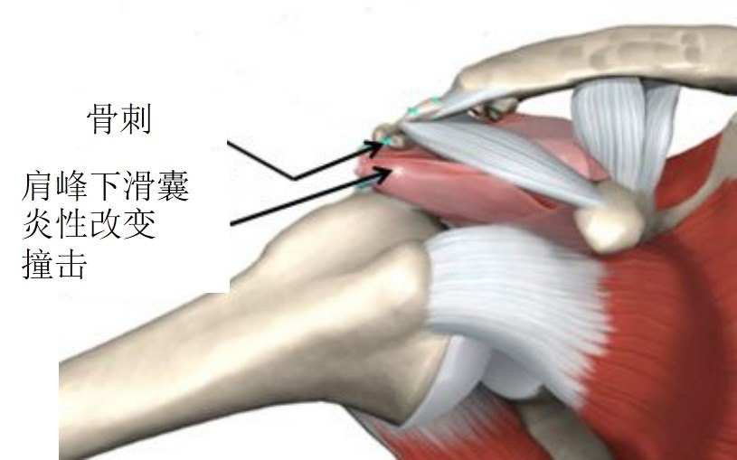 肩峰前外侧端形态异常,骨赘形成,肱骨大结节的骨赘形成,肩锁关节增生