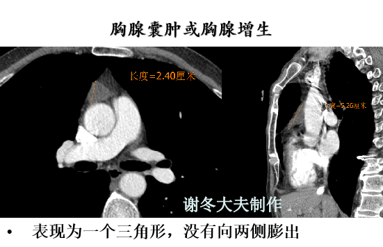 胸腺退化不全是什么意思ct表现跟胸腺残留胸腺增生或胸腺瘤有什么区别