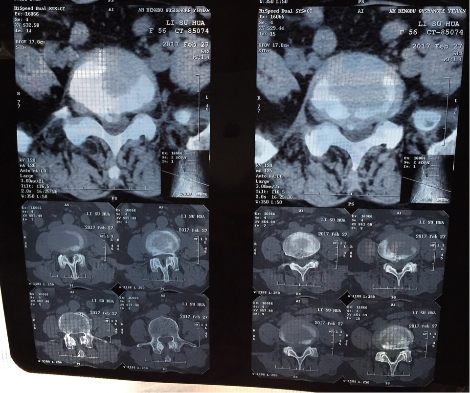 腰椎间盘突出 l3椎体向前滑脱 椎管狭窄