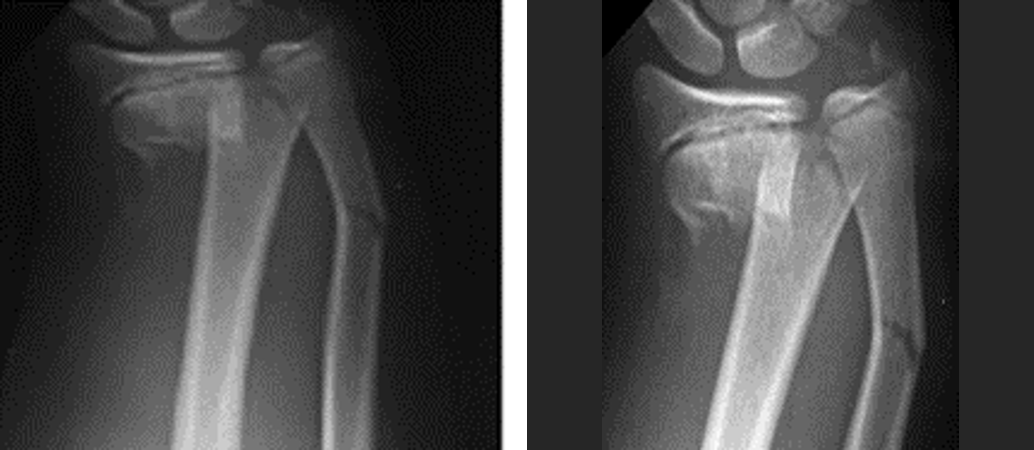 腕关节骨折桡骨远端