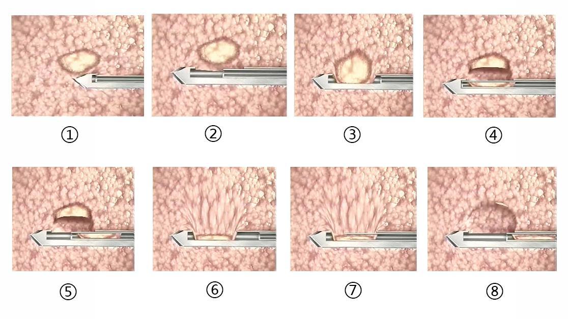 原创乳腺良性结节的微创旋切术是如何进行的