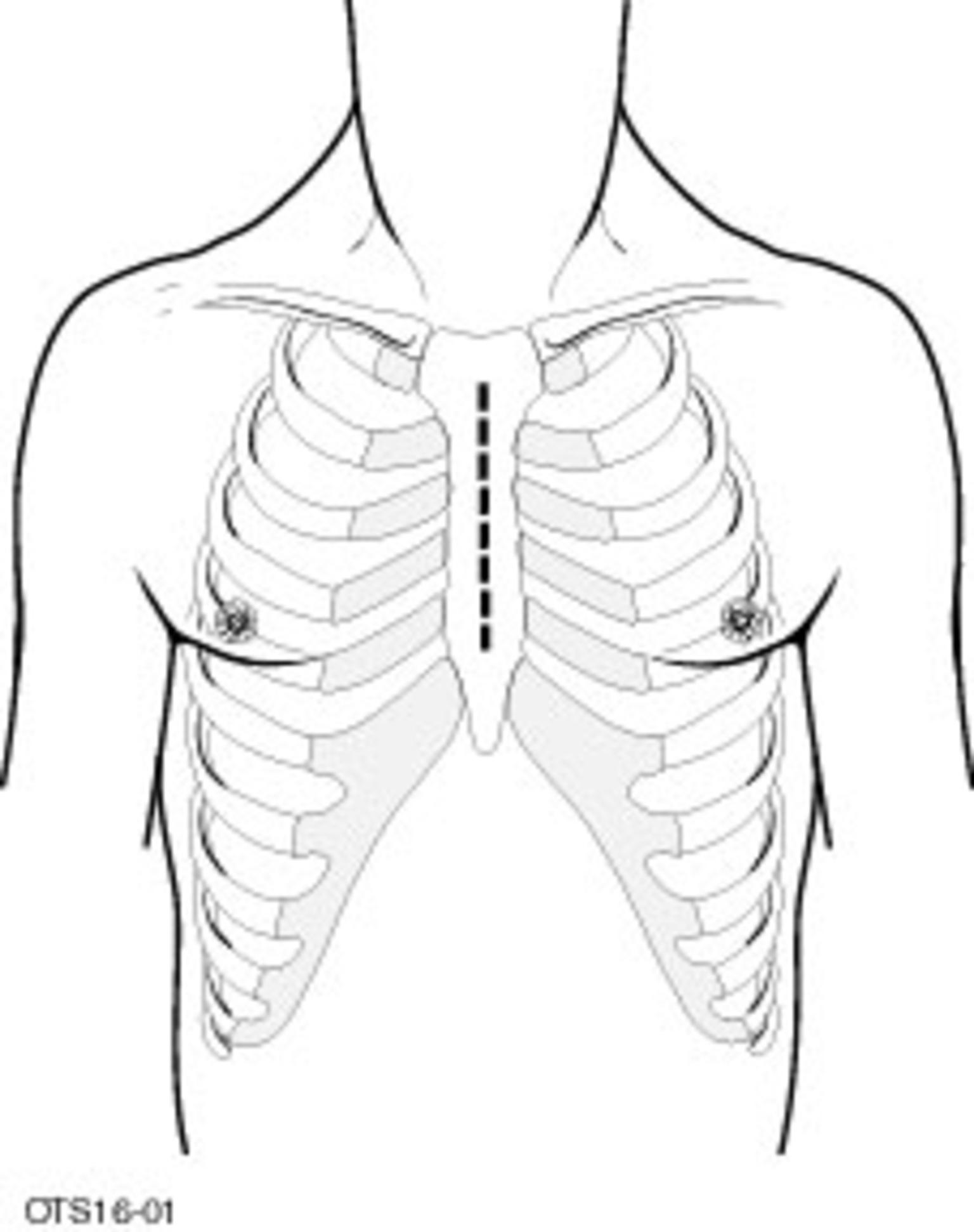 前纵隔肿瘤所在的位置:胸骨后两侧胸膜腔的中间间隔部分.