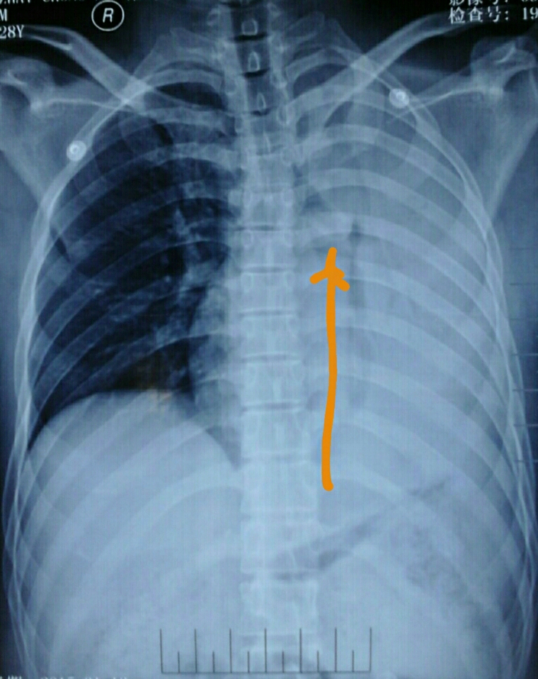 先看影像学检查:胸片,ct,看到了左主支气管内异物以及阻塞性肺不张.