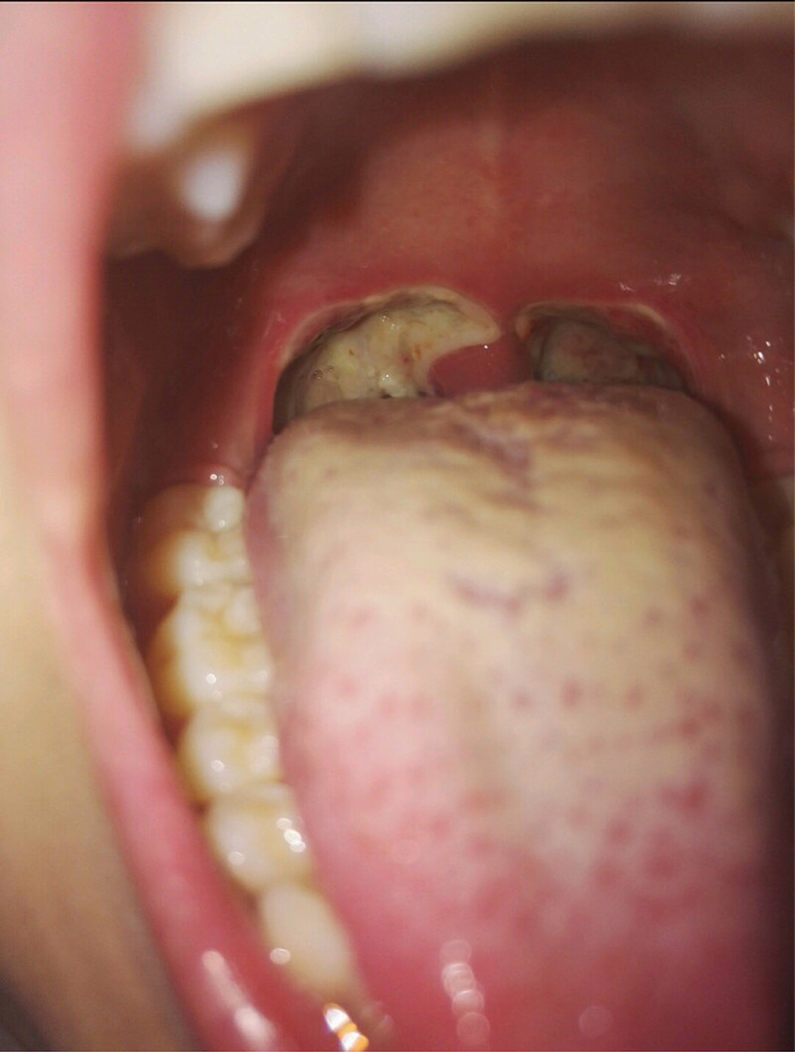 1,为什么术后10几天内口内鼻内非常臭上图显示扁桃体窝内白色的为伪膜