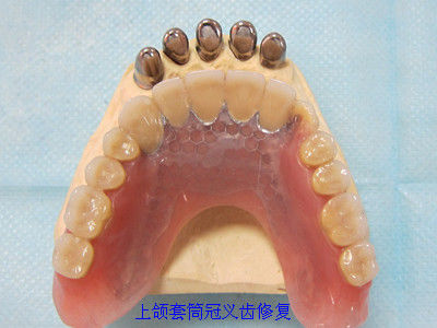 种植牙和套筒冠义齿修复病例照片