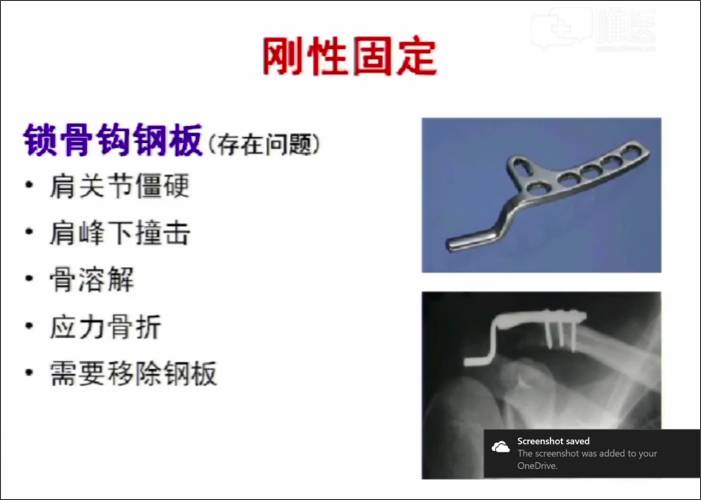 78亮点二:以肩锁钩钢板为代表的刚性固定存在的缺点.