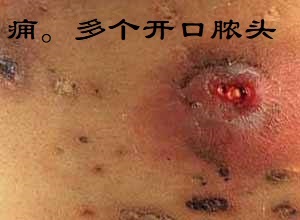 毛囊炎疖子痈皮脂腺囊肿这样分的清