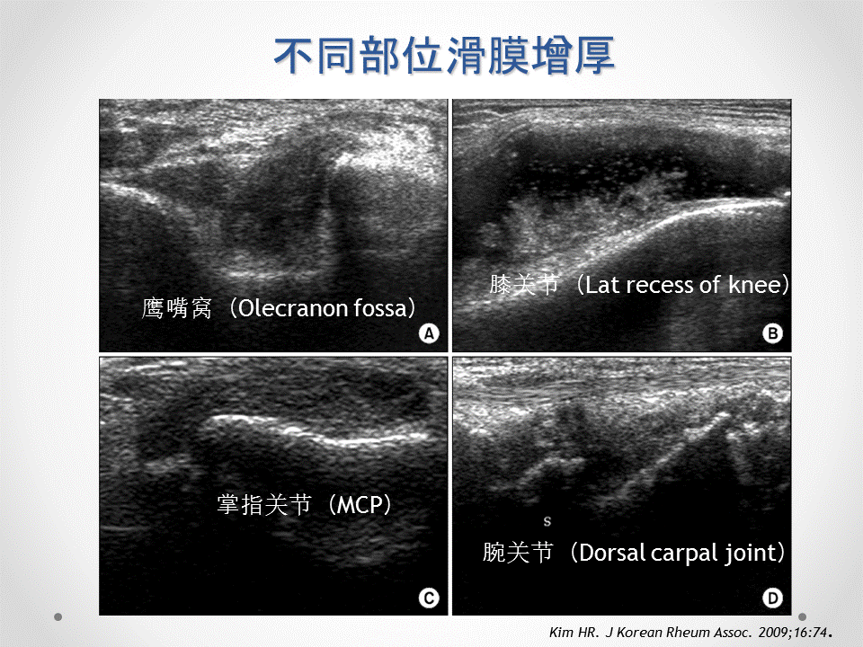 不肿不痛关节炎就好了么关节超声帮你找出潜伏亚临床滑膜