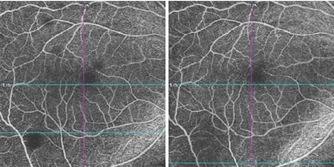 我国眼底相干光层析血管成像术的操作和阅片规范2017年