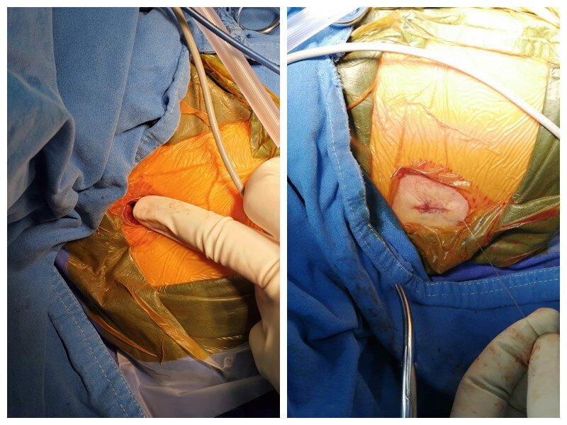 男生敏感神经阻断手术(男生敏感神经阻断手术副作用)