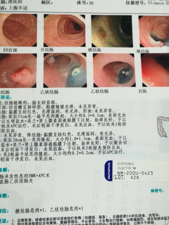 深度体检有多重——从发现一例结肠原位癌说起