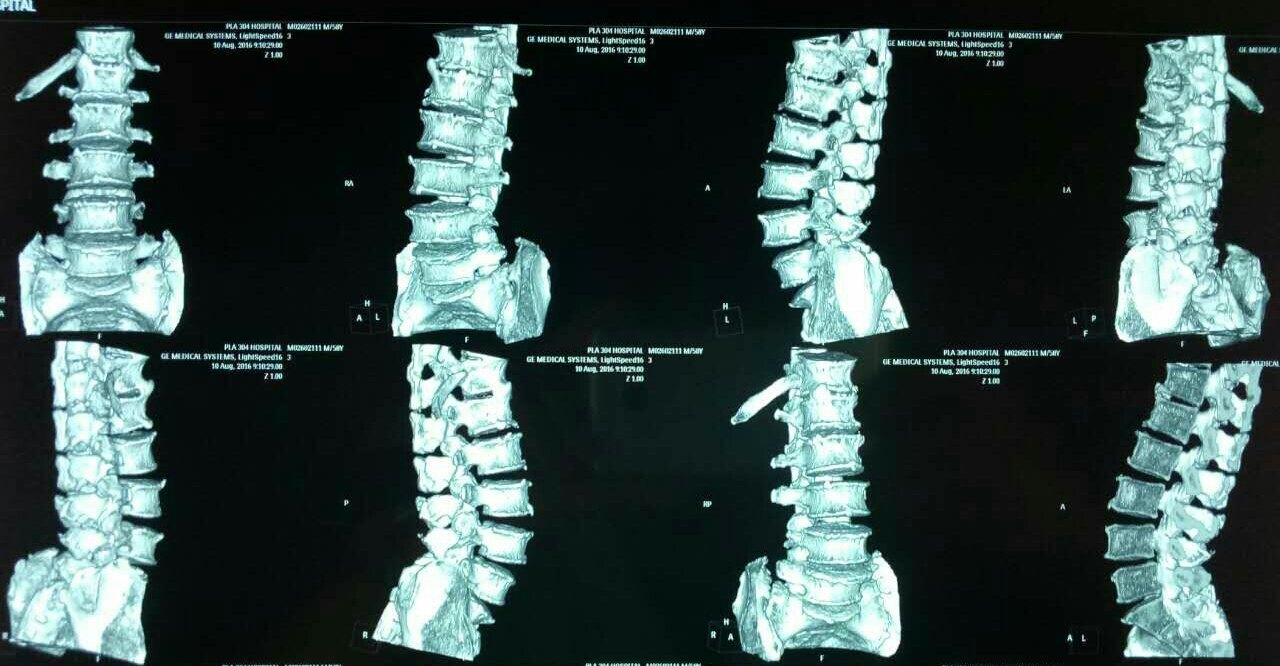 发现椎体骨折发现椎间盘突出ct,又叫计算机断层扫描.