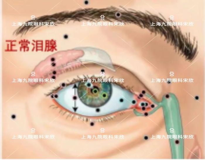 眼球逐渐移位当心泪腺肿瘤作怪