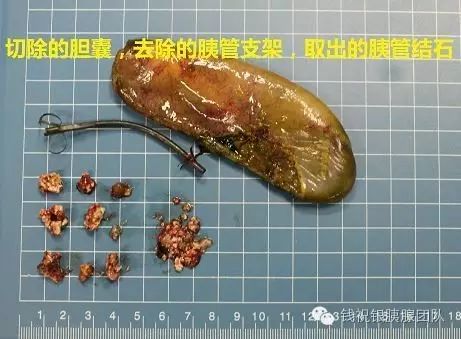 胰管结石慢性胰腺炎的引流手术