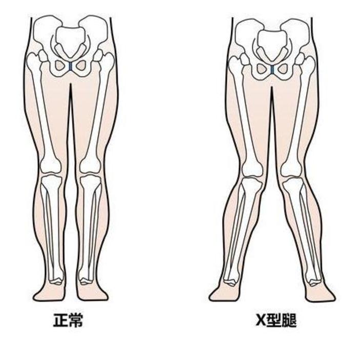 小孩8岁还是x型腿该如何有效纠正