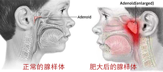 腺样体疾病多发生于儿童,部分成人也可发生.