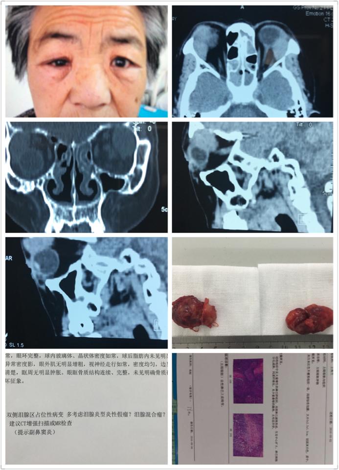 ct诊断炎性假瘤,病理诊断:泪腺良性淋巴上皮病变.