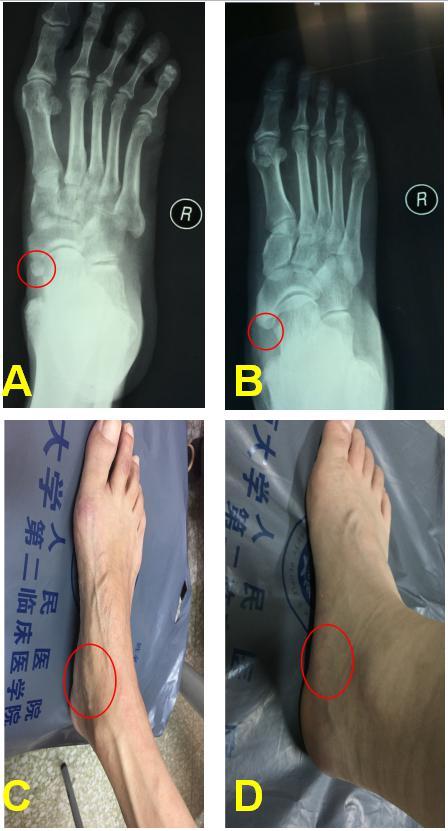 足的副舟骨是什么梗看完这篇文章就全明白了