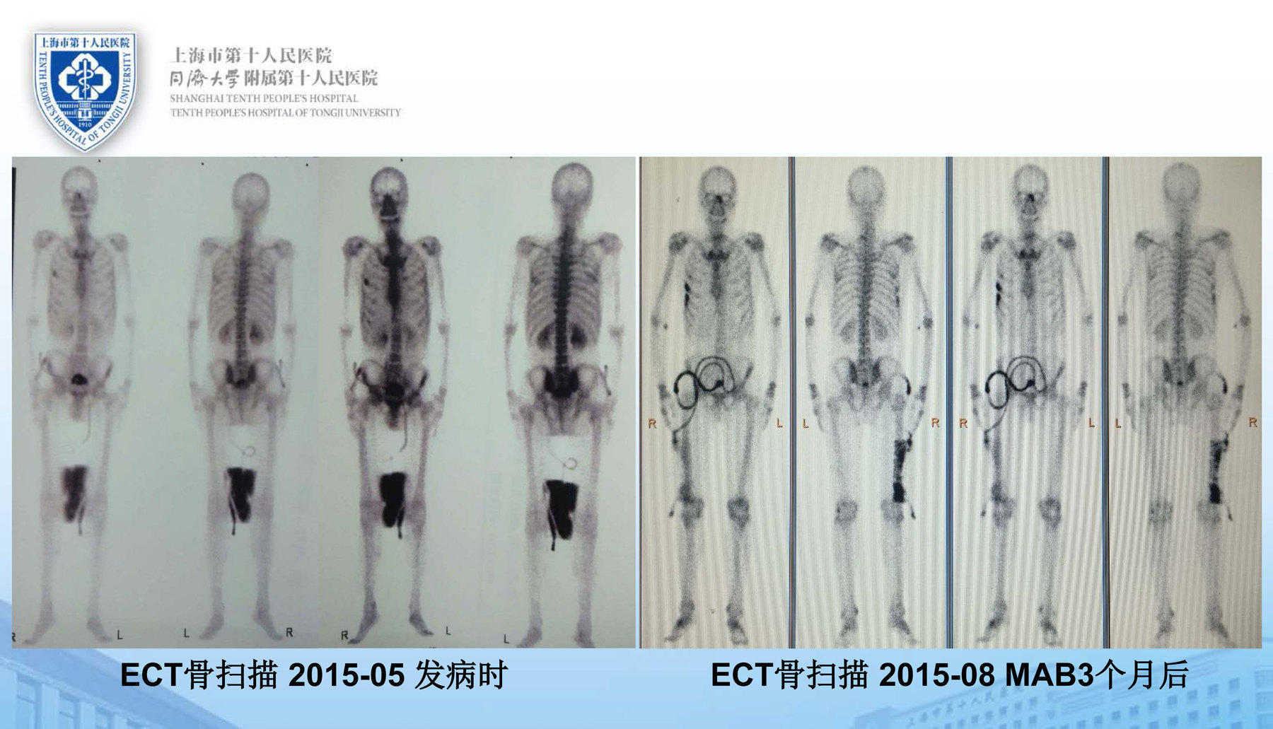 一例超级复杂t4期前列腺癌的手术治疗