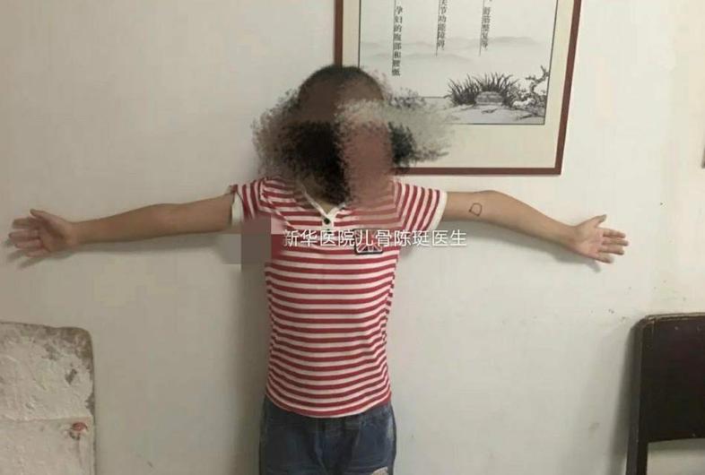 儿童发生肘内翻的常见原因是什么怎样治疗