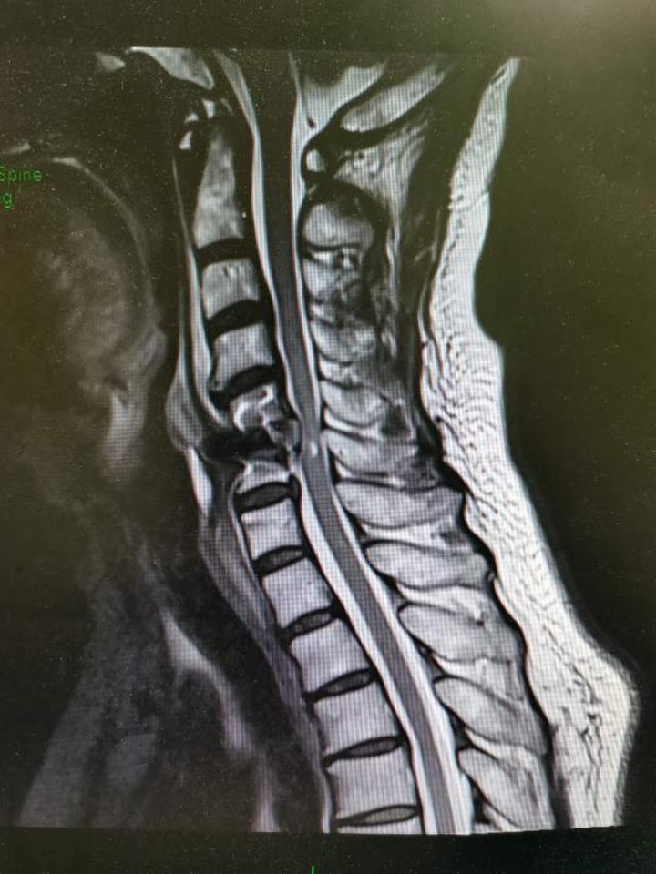 手麻没劲走路发飘的元凶—颈椎后纵韧带骨化症 - 微医(挂号网)