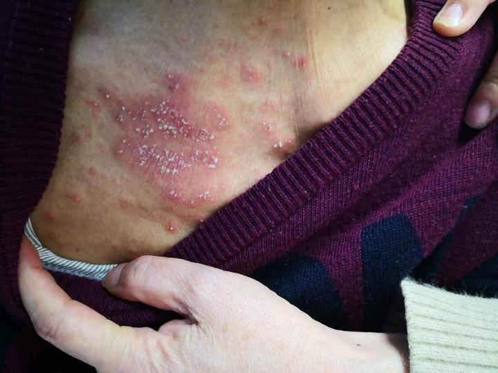 马尔尼菲青霉素病历一例 - 微医(挂号网)