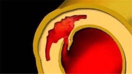 典型的主动脉夹层胸痛是腰背部撕裂样疼痛或者刀割样疼痛,跟心肌梗死