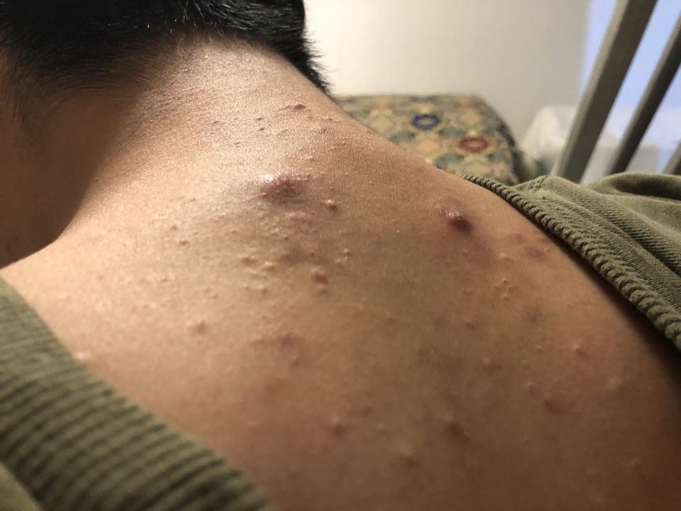梅毒疹后背疙瘩照片图片