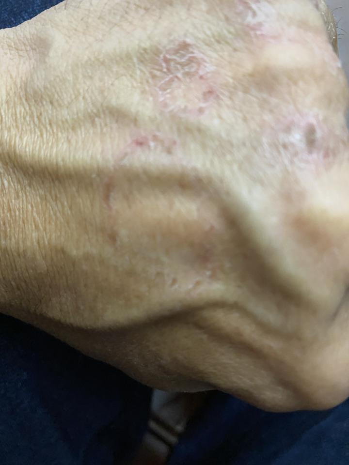 手背红斑