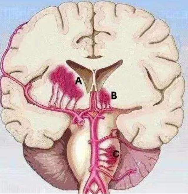 脑梗位置图片图片