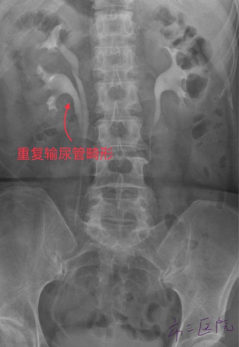 4:对于肾或输尿管结石患者,建议术前常规行ct检查或静脉肾盂造影检查