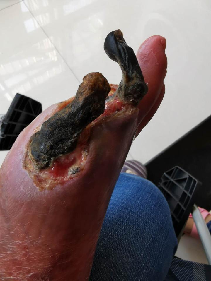 可怕的脉管炎不要怕